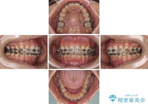 上顎前突をしっかりと治す　補助装置を使用したワイヤー矯正の治療中