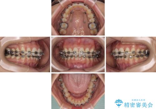 上顎前突をしっかりと治す 補助装置を使用したワイヤー矯正の治療中