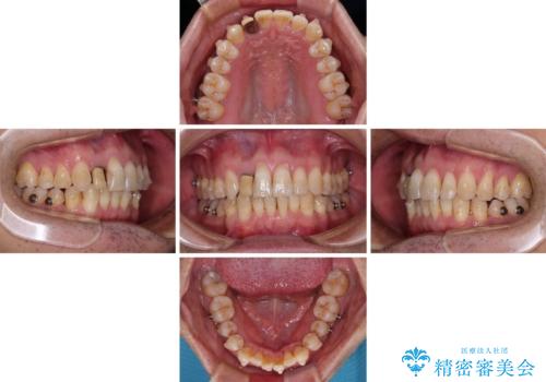 前歯のデコボコを治したい　インビザラインによる矯正治療の治療中