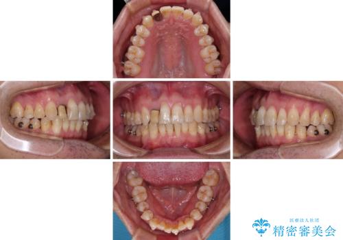 前歯のデコボコを治したい インビザラインによる矯正治療の治療中