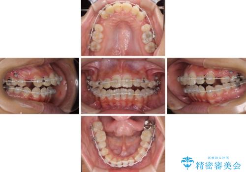 開咬と前突を改善　ワイヤー装置での抜歯矯正の治療中