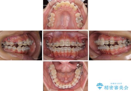 開咬と前突を改善 ワイヤー装置での抜歯矯正の治療中