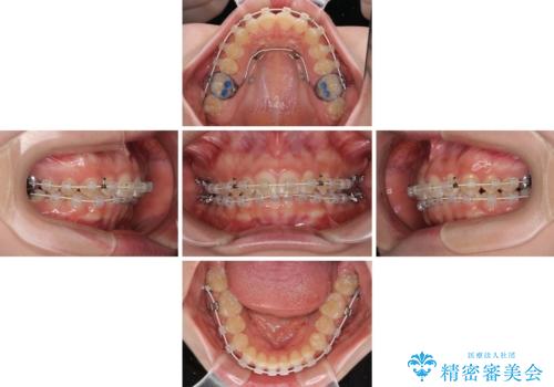 ディープバイトを短期間で改善　ワイヤー矯正治療の治療中
