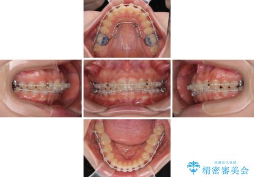 ディープバイトを短期間で改善 ワイヤー矯正治療の治療中