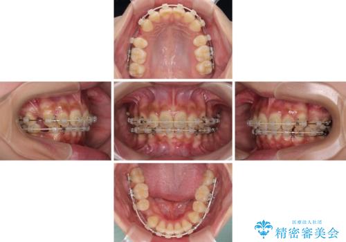飛び出した前歯と八重歯を改善　ワイヤー装置での抜歯矯正の治療中