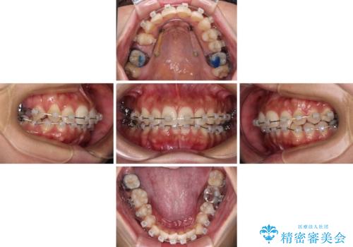 目立つ八重歯を改善　ワイヤー装置での抜歯矯正の治療中