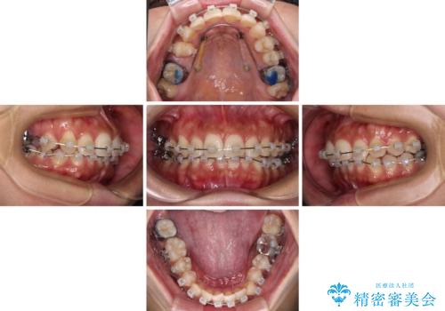 目立つ八重歯を改善 ワイヤー装置での抜歯矯正の治療中