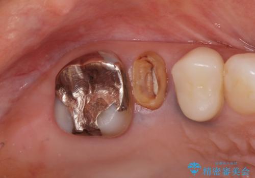 割れてしまった奥歯 セラミックブリッジ治療の治療前