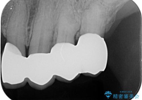 咬合の崩壊　金属床義歯で咬合機能の回復の治療後