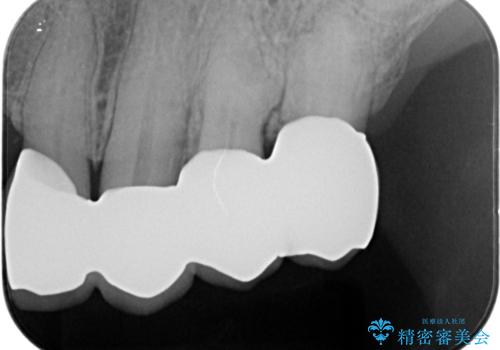 咬合の崩壊 金属床義歯で咬合機能の回復の治療後