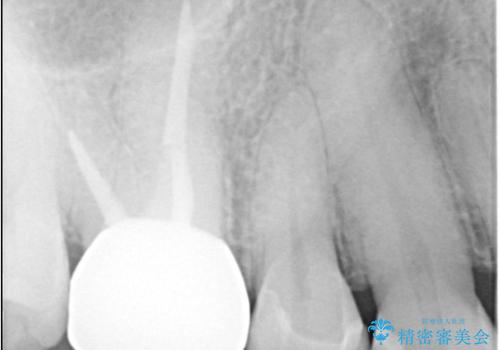 【セラミックインレー】メタルフリーの治療の治療後