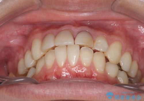 前歯の変色 審美性の改善の治療前