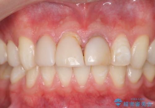 前歯の変色 審美性の改善の治療前