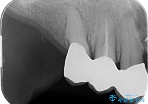 咬合の崩壊 金属床義歯で咬合機能の回復の治療後