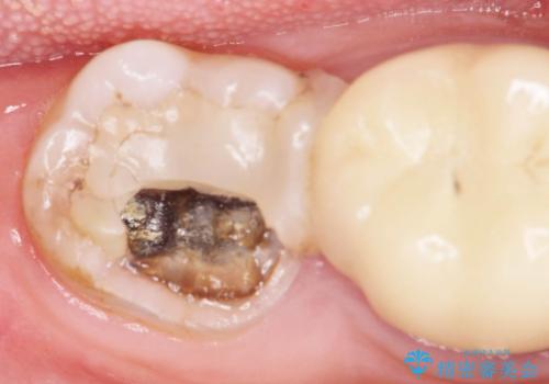 インレー下に再発した虫歯 セラミッククラウンによるやり替えの症例 治療前