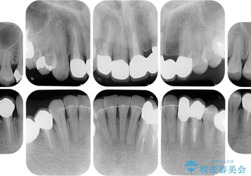 非対称の前歯を整えたい 矯正治療と審美治療の総合歯科診療の治療後