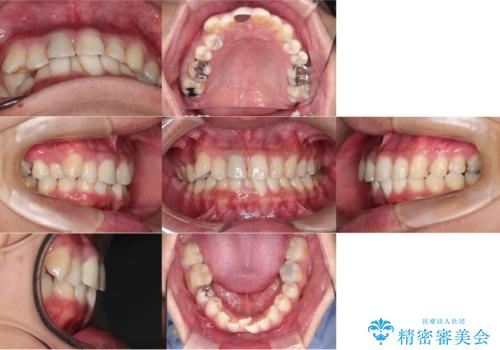 【インビザライン】八重歯と歯のでこぼこが気になる!の治療中