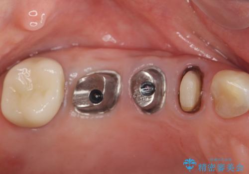 過大な咬合力で破折した奥歯　インプラント治療で咬合機能の回復の治療中