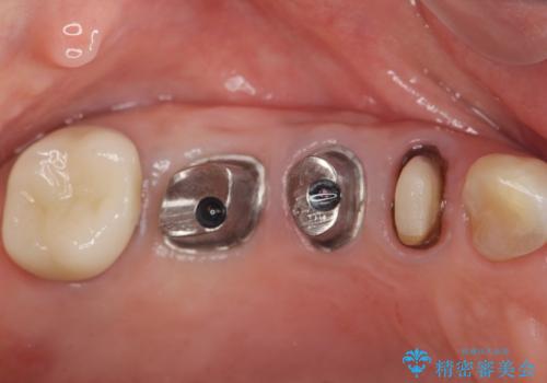 過大な咬合力で破折した奥歯 インプラント治療で咬合機能の回復の治療中