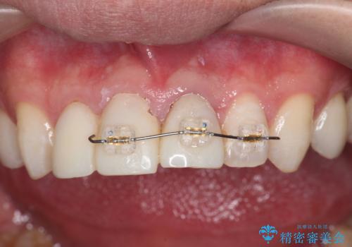 前歯の変色 審美性の改善の治療中