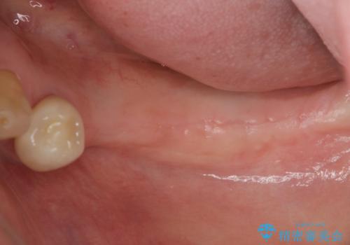 入れ歯を無くした インプラント治療の希望の治療前