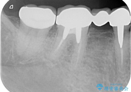 インレー下に再発した虫歯 セラミッククラウンによるやり替えの治療後
