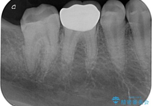 セラミックの詰め物が欠けたのでやり替えたい オールセラミッククラウンの治療後