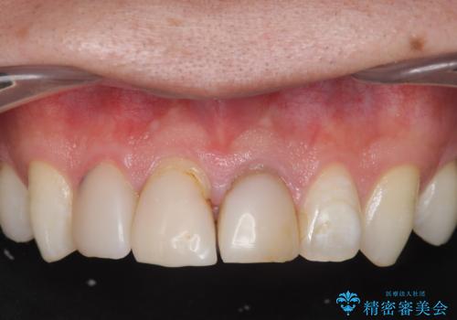 前歯の変色 審美性の改善の症例 治療前