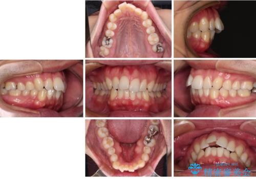 口元が出ているのが気になる。審美装置による抜歯矯正の治療前