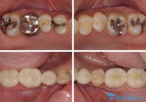 非対称の前歯を整えたい 矯正治療と審美治療の総合歯科診療の治療後