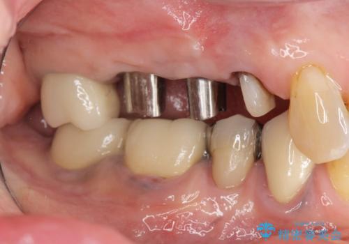過大な咬合力で破折した奥歯　インプラント治療で咬合機能の回復の治療中
