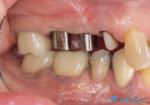 過大な咬合力で破折した奥歯 インプラント治療で咬合機能の回復の治療中