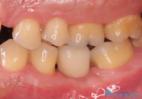 奥歯の欠損 インプラント治療の治療後