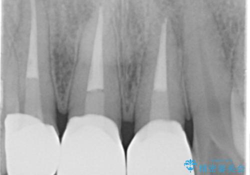 前歯の変色 審美性の改善の治療後