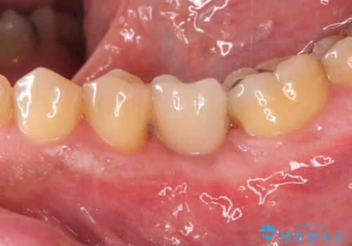 奥歯の欠損　インプラント治療の治療後