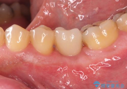 奥歯の欠損 インプラント治療の症例 治療後