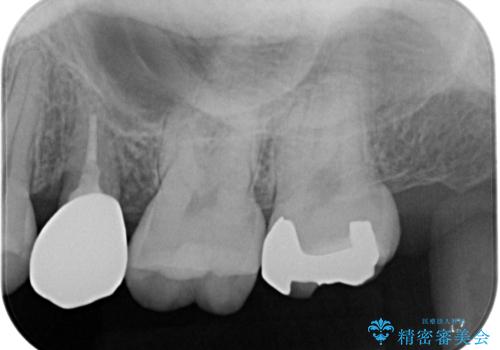 虫歯になった気がするので治療したい　ゴールドインレー修復の治療後