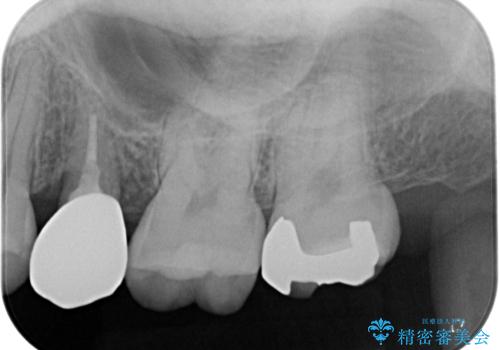 虫歯になった気がするので治療したい ゴールドインレー修復の治療後