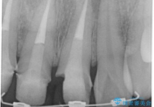 前歯の変色 審美性の改善の治療中