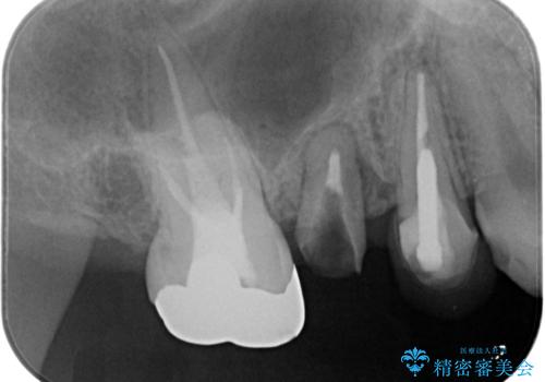 割れてしまった奥歯 セラミックブリッジ治療の治療前