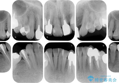 非対称の前歯を整えたい 矯正治療と審美治療の総合歯科診療の治療前