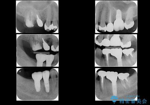 歯が割れているといわれた 奥歯にインプラントをしていきたい 全体的な治療の治療前