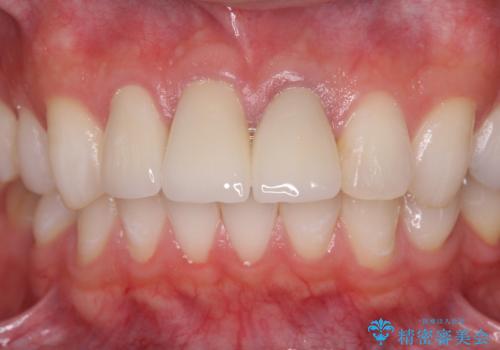 前歯の変色 審美性の改善の治療後