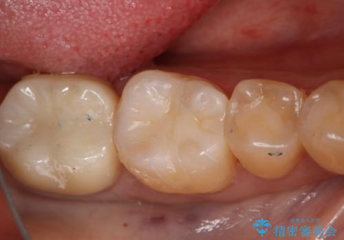 奥歯にセラミックを入れたいの治療後