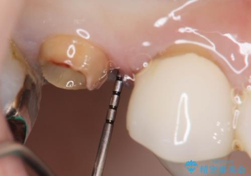 割れてしまった奥歯 セラミックブリッジ治療の治療中