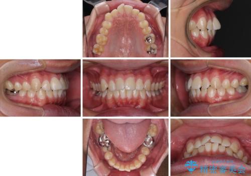 楽してデコボコを治したい ワイヤー矯正治療の治療前