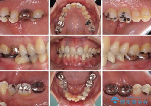 非対称の前歯を整えたい 矯正治療と審美治療の総合歯科診療の治療前