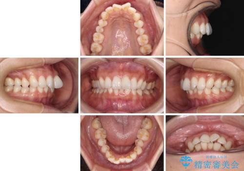 上顎前突をしっかりと治す　補助装置を使用したワイヤー矯正の治療前