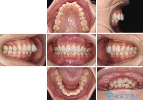 上顎前突をしっかりと治す 補助装置を使用したワイヤー矯正の治療前