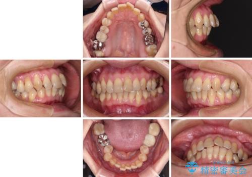 マウスピース矯正とセラミック治療で綺麗な口元にの治療前